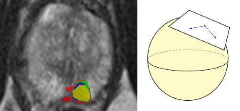 RieMAE: Self-Supervised Riemannian Autoencoder for Prostate Cancer Detection